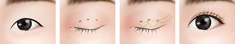 小眼睛薄皮肤 手术方法