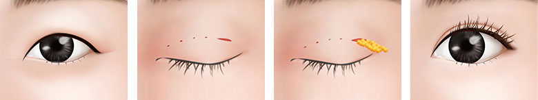 小眼睛厚皮肤手术方法1