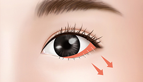 在外眼角下侧结膜处切最小切口，向下拉成自然的角度，然后牢牢固定。